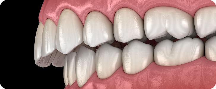 돌출입/무턱 교정